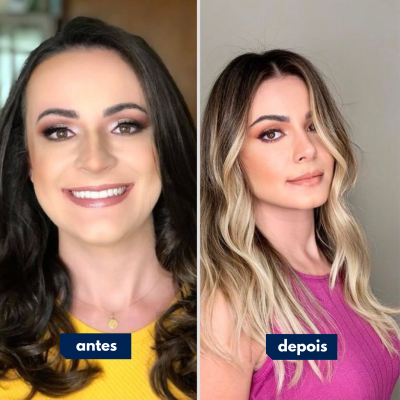 Antes e depois de cirurgia feita pelo Dr. Rafael Geminiani