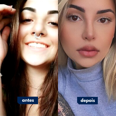 Antes e depois de cirurgia feita pelo Dr. Rafael Geminiani