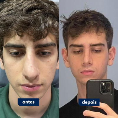 Antes e depois de cirurgia feita pelo Dr. Rafael Geminiani