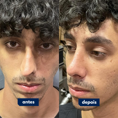 Antes e depois de cirurgia feita pelo Dr. Rafael Geminiani