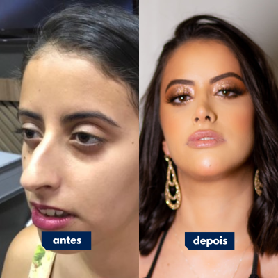 Antes e depois de cirurgia feita pelo Dr. Rafael Geminiani