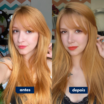 Antes e depois de cirurgia feita pelo Dr. Rafael Geminiani